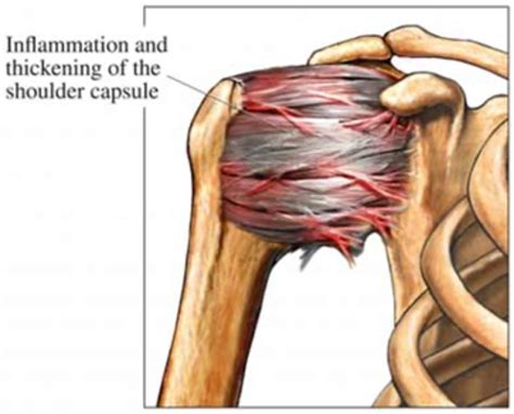 Capsulitis Adhesiva - Lesiones de Hombro | Dr Eugenio Díaz