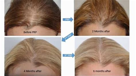 Top 48 image hair implants for women - Thptnganamst.edu.vn