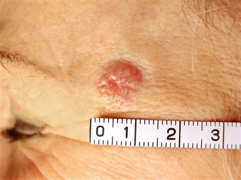 Basal-cell skin cancer (Basalioma): Causes, symptoms and treatment | Hyperthermia Centre ...