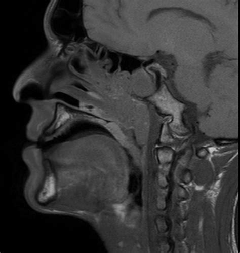 Nasopharyngeal Angiofibroma-MRI - Sumer's Radiology Blog