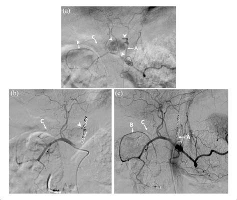 (a) An angiogram of the celiac artery. Label A represents the left... | Download Scientific Diagram