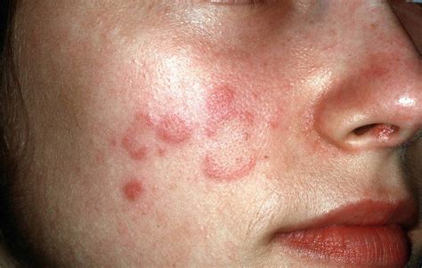 Lupus Rash On Face