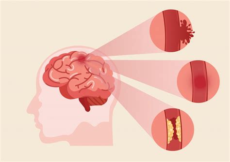 ENFERSALUD: ¿QUÉ ES EL ACCIDENTE CEREBROVASCULAR?