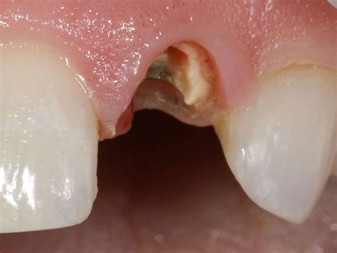 Extract Broken Root - Family Dental Clinic