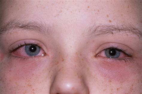 Allergies - Symptoms - NHS