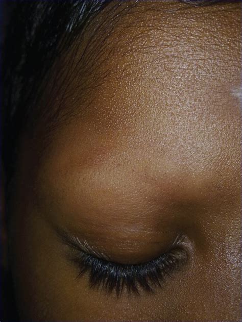 Total eyebrow loss in a child with alopecia areata | Download Scientific Diagram