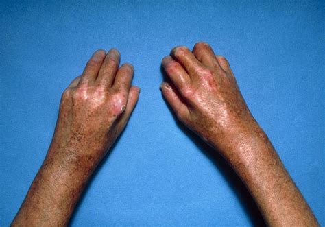 Shiny Toughened Skin On Hands Due To Scleroderma Photograph by - Pixels