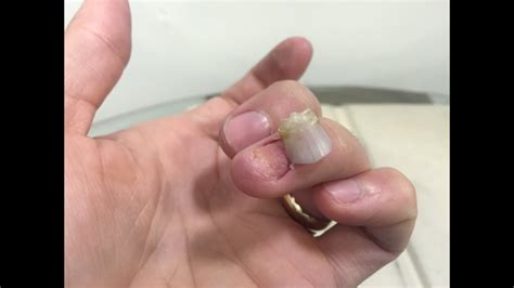 Removing my fingernail / Amputating my fingernail (link in description ...