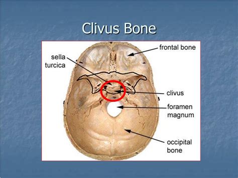 PPT - Clivus Bone Metastasis: Review of Cranial Nerves PowerPoint ...