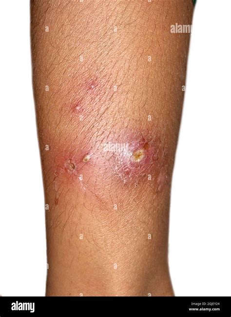 Cellulitis infection child hi-res stock photography and images - Alamy