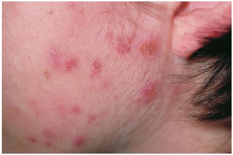 Can you identify this spreading, itchy rash? | Consultant360