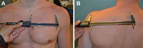 Scapular index measurement. (A) Sternal notch to coracoid process... | Download Scientific Diagram