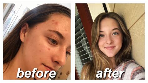 ACCUTANE FOR MILD ACNE // my story & monthly updates - YouTube