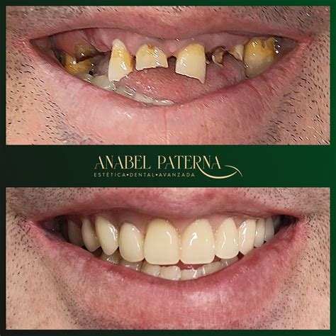 Antes y después implantes dentales | Anabel Paterna | Clínica dental