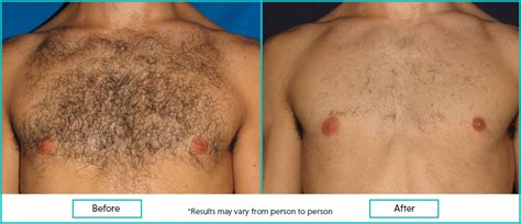 How To Remove Chest Hair: Temporary Vs Permanent Methods