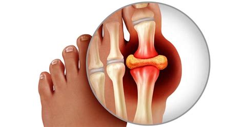 Why does my big toe joint hurt- A Podiatrist's View • Unisoles