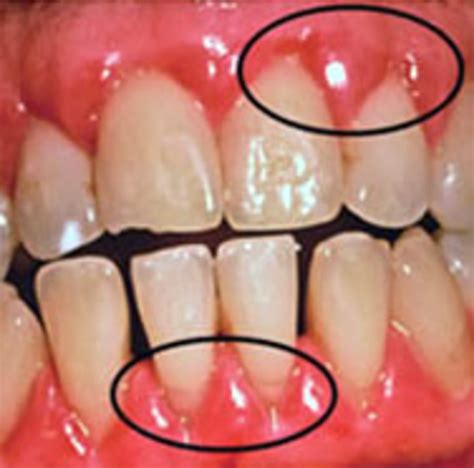 Painless Lump On Gum