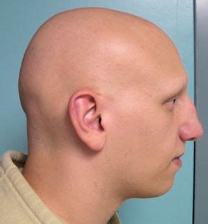 Treatment for Alopecia Totalis and Alopecia Universalis