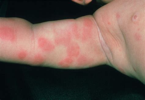 Food Allergy Skin Rash Baby