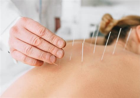 DRY NEEDLING -WHY OUR PATIENTS RAVE ABOUT IT AND WHY YOU WILL TOO ...