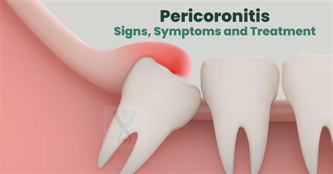 Pericoronitis Signs, Symptoms &Treatment | Wisdom Tooth