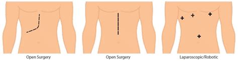 Liver Resection