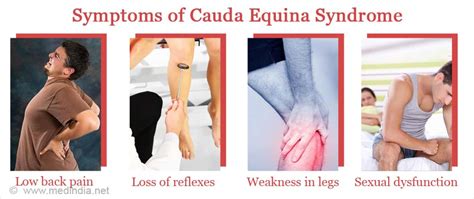 Cauda Equina syndrome (CES)