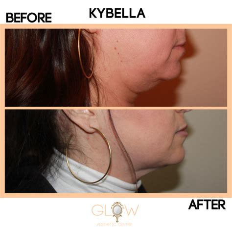 Kybella - Los Angeles Medical Spa: Encino | Tarzana | Woodland Hills | Calabases