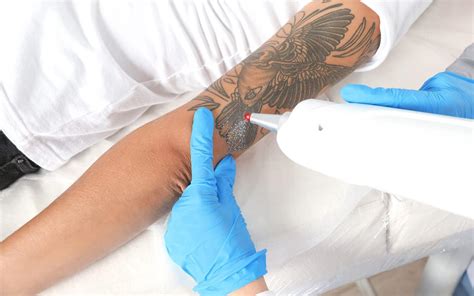 Laser tattoo removal aftercare - Goodbye Tattoos