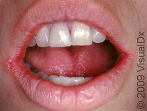 Candida Albicans Lips