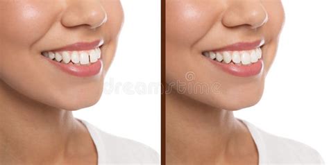 Collage with Photos of Woman with Diastema between Upper Front Teeth ...