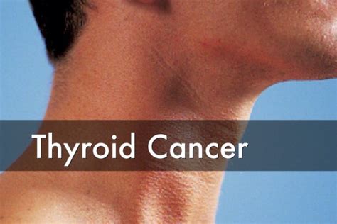 Types of Thyroid Cancer