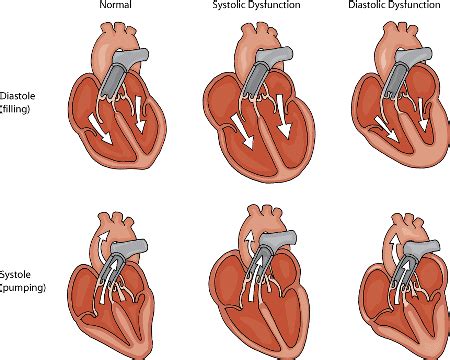 What Is Congestive Heart Failure In Dogs