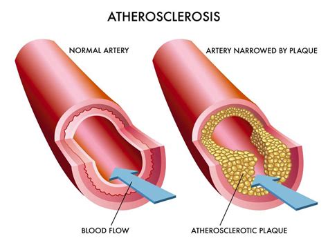 What is the impact of arteriosclerosis? | Socratic