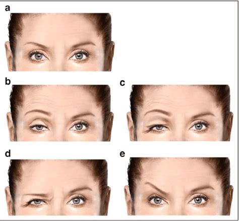 Collection 95+ Images Pictures Of Ptosis Of The Eye Excellent