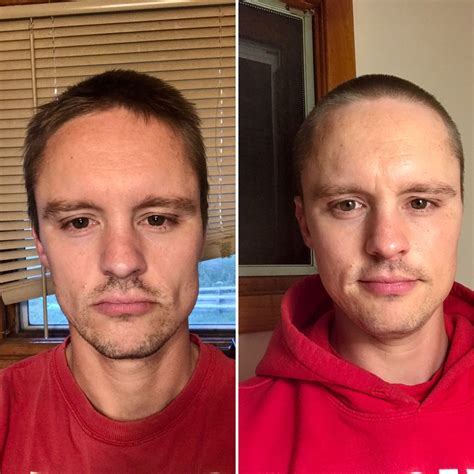 3 Months Carnivore Diet Before and After Picture – Diet & holistic health – Acne.org Forum