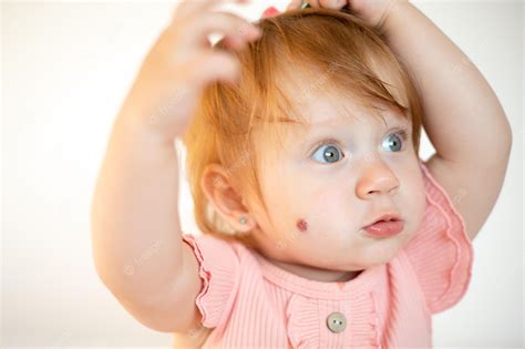 Red Birthmark on the Face: Causes, Types, and Treatment Options - Itechment