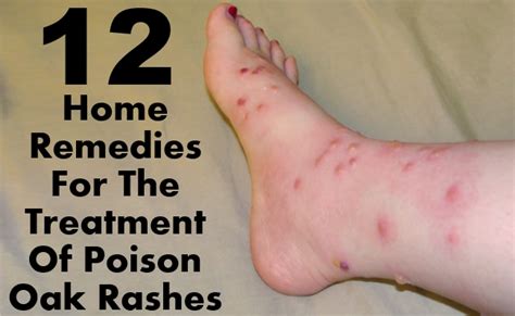 12 Effective Home Remedies For The Treatment Of Poison Oak Rashes – Morpheme Remedies | India