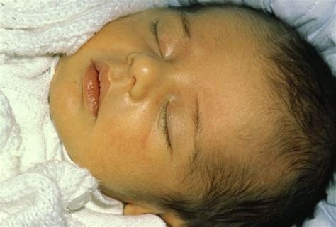 Neonatal Jaundice Ppt