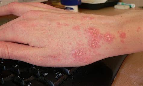 What Does Scabies Look Like