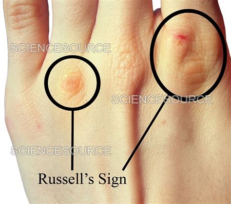 Photograph | Russell's Sign | Science Source Images