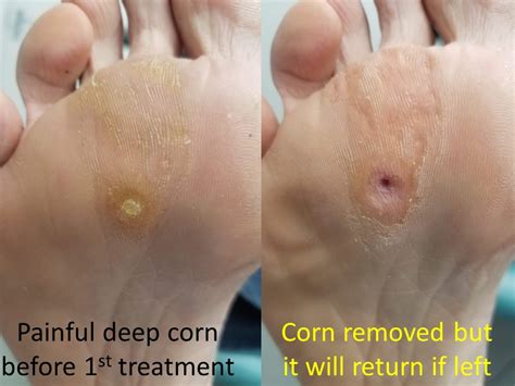 What Is A Corn On The Foot Sale | emergencydentistry.com