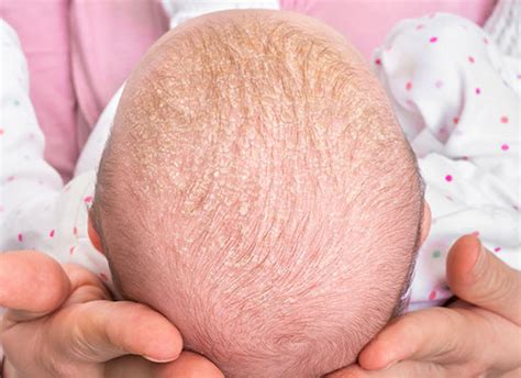 Seborrheic Dermatitis Infant Body