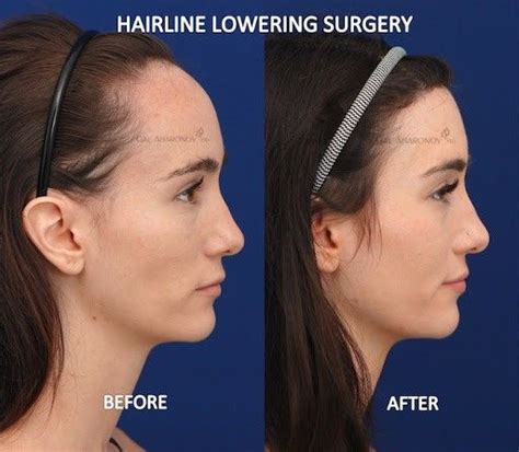 Pin by Meghan Scott on Beauty | Forehead reduction, Forehead reduction ...