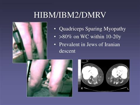 PPT - HIBM Hereditary Inclusion Body Myopathy PowerPoint Presentation, free download - ID:1227960