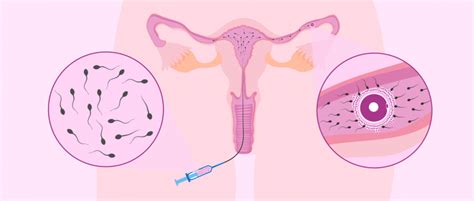 Intrauterine insemination