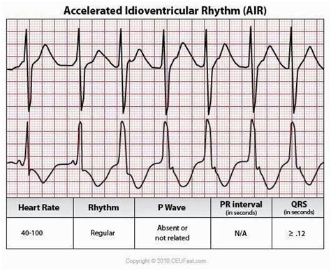 Pin by Sarah Beasleigh on Ekg | Ecg interpretation, Ekg, Nursing school life