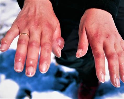 Frostbite - Causes, Prevention, Signs, Symptoms & Frostbite Treatment