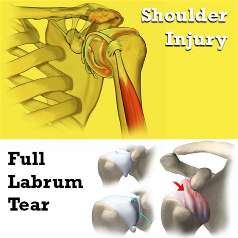 I WANT A NEW SHOULDER!!!!! X-Gains | Working Out Around An Injury ...