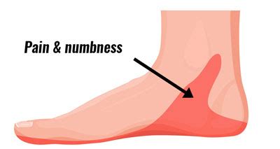 Most Likely Causes Of Pain In The Foot Arch Symptoms Treatments — Feet ...